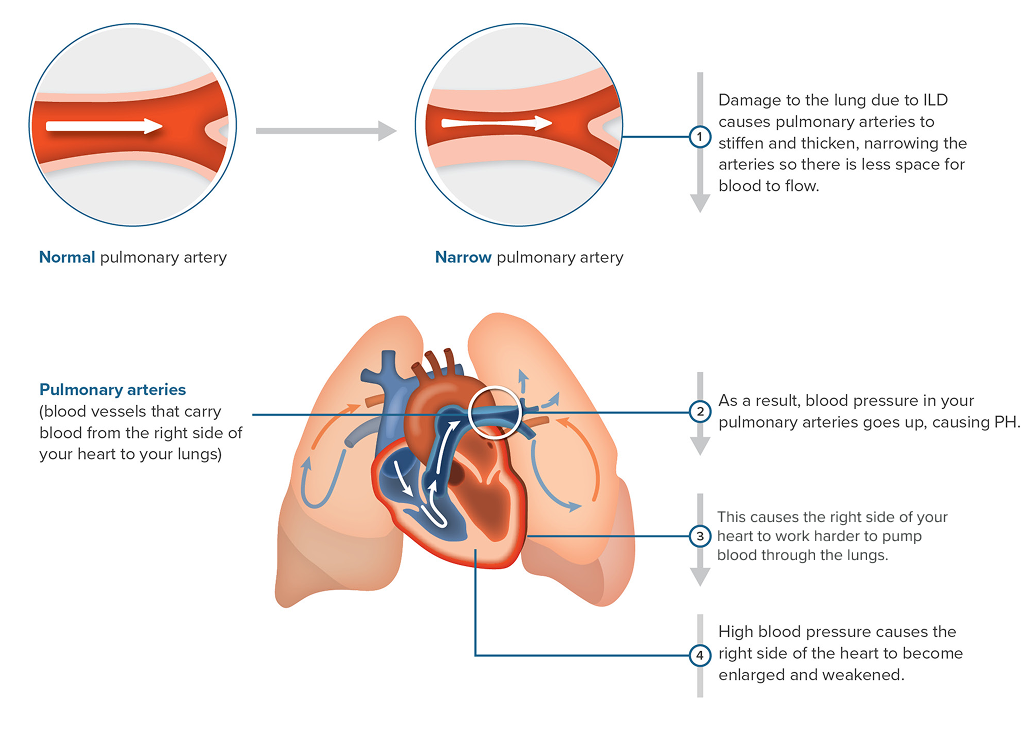 Illustration explaining how PHILD is a disease where there is high blood pressure in the arteries of your lungs, which causes the heart to work harder, becoming enlarged and weakened