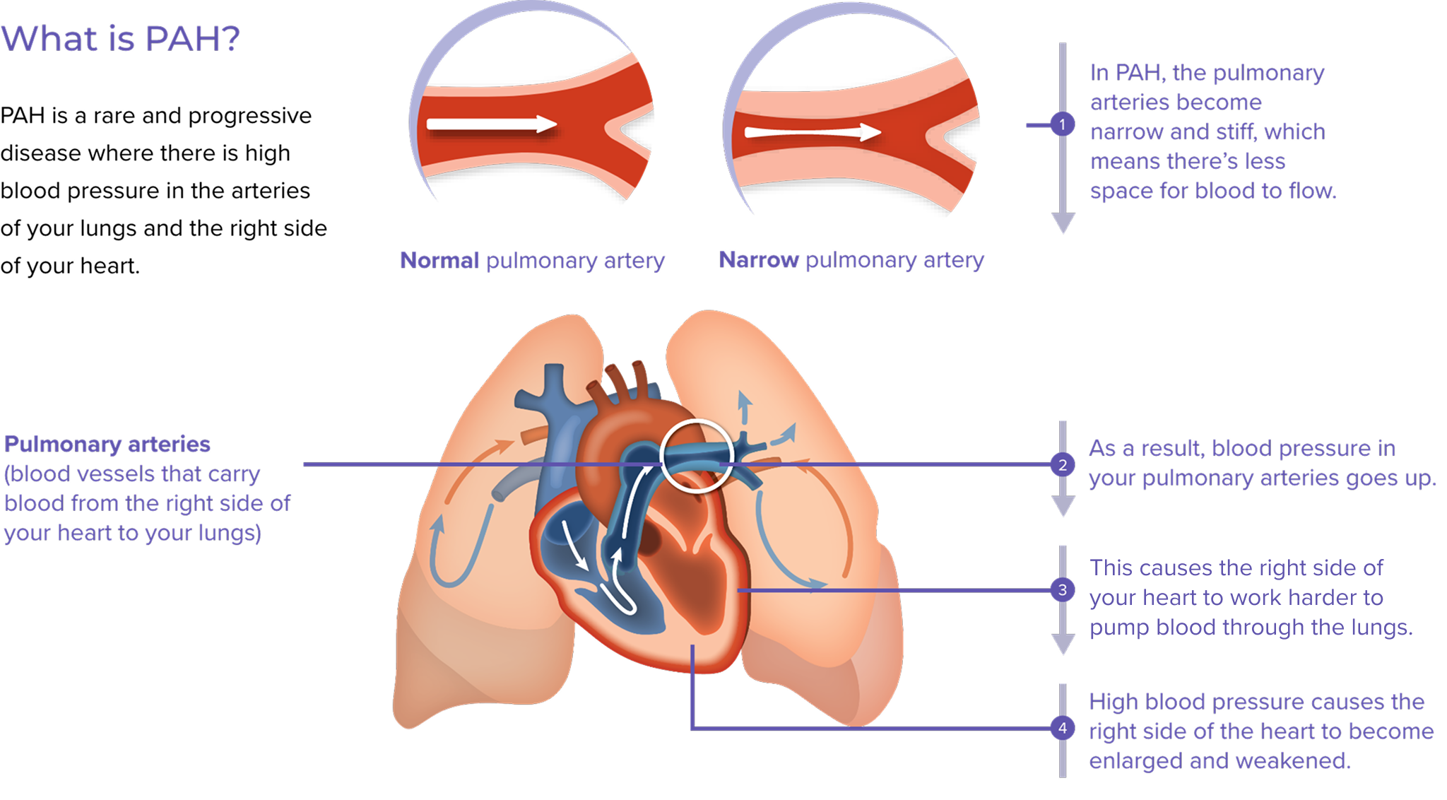 Illustration explaining how PAH is a disease where there is high blood pressure in the arteries of your lungs, which causes the heart to work harder, becoming enlarged and weakened Illustration explaining how PAH is a disease where there is high blood pressure in the arteries of your lungs, which causes the heart to work harder, becoming enlarged and weakened